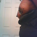 Side view - 1 week post op
