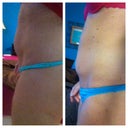 Before and 10 days after side