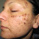 march 3 1 week after second treatment