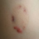 Laser treatment on hyperpigmentation