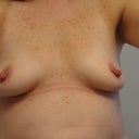 2 weeks post op