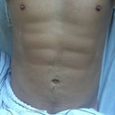 Seventeen days post surgery. I love sleeping in my foam compression belt! I wish it would stay like this but it swells during the day. Getting better though.