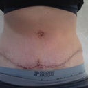This is 13 days post op, seeing my scar for first time. I'm not sure what to think but it really looks ugly! I'm hoping it will smooth over.