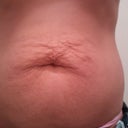 Pre Op belly