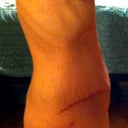 5 weeks post op pic