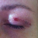 13 days post op, this is a scab that formed around a tiny opening that i had when i must have pulled a stitched out by accident. Letting it heal as is
