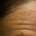 This is a close up of my forehead so you can see the orange-peel texture. HORRIBLE.
