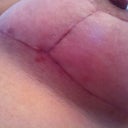 6 Wks PO: right breast incision. Posting these to compare to my 12 day po pics.