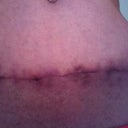 6 Wks PO: front of incision line. You can see how it migrated up. Hopefully those areas will lighten over time.