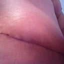 6 Wks PO: right side of TT incision.