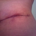 6 Wks PO: left side of TT incision.