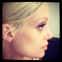 1.5 years after open rhinoplasty - profile view