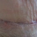 pic is just taking off the CG I wear at night to reduce the fluid build up you can see a little seeping,