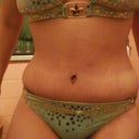 Post Opt Day 17 or 2 weeks 3 days