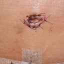 Day 8-Close up of my new belly button