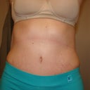 5 weeks post op