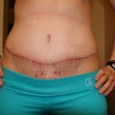 5 weeks post op!! YAY!