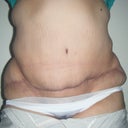 notice the scar is in a "diagonal" position and im super uneven everywhere