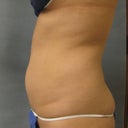 before pic, took on 2/18, side
