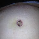 2 weeks post op