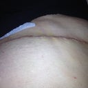 Two weeks post op