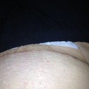 2 weeks post op
