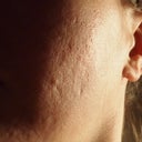5 days after second treatment.  Left side of face.  Shows my type of scarring and maybe in a few weeks or months I can post another photo showing some improvement.  Kind of sad but this IS an improvement in scarring, wish I took a photo before the first treatment.  You can also see split pores, my rolling scarring, and a few ice picks as well.