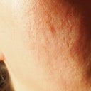 5 days after second treatment.  Right side of face.  You can see how red the big scar is in the centre considering this particular pimple occurred 15 years ago.  It was big, I remember it lol.  You can also see split pores, my rolling scarring, and a few ice picks as well.