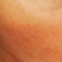 5 days after second treatment.  Right side of face.  You can see the big red scar from the second photo in the bottom center of this photo.  Just wanted to show how red I am 5 days after which is not too red.  As I mentioned in my post I hope I don't have any residual hyperpigmentation and will post an update later.