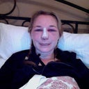 Day After Surgery- really really swollen