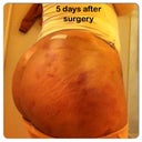 5 days after...butt still hard and some bruising.