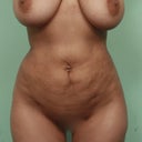 Liposcuplture