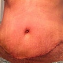 This is about ten days post surgery.  I just took the steristrips off, and you can see how swollen.  This looks VERY scary, but this is the worst that it has looked.  The lumpiness around the scar is what freaked me out the most.
