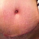 This is just three days later, right before my two week check up.  See how much better the scar looks already?  And the playdoh lumpy look is almost gone.  And hello, cute belly button!! <3