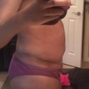 17 days PO (side view).  Swelling around my BB and in my pubic area.
