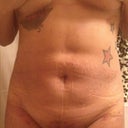 post op 1 week 2 days