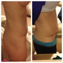 Left: first thing in the morning, Right: after a 17 hour day at school...almost 5 months postop