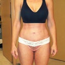 3 months post op. No scars are visible from the front or back when standing like this.  Amazing!