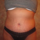 8 wks PO. front view, Hematoma swelling still visible but much better.