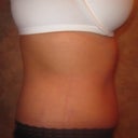 8 wks PO. Right side view.