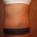 8 wks PO. Left side hematoma view.