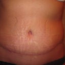 8 wks PO. Close up of scar and hematoma swelling. The scar on the hematoma side is still higher up than the right side but it has definitely come down since the first week.