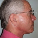 Neck Lift In 68 Year Old Man