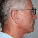 Neck Lift In 68 Year Old Man