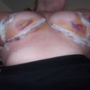 4 Days post op