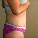 side view post op 4 weeks