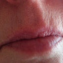 pic of my lips before Perma Facial Implant, taken by me with my cell phone.
