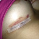 Day 3 - R incision