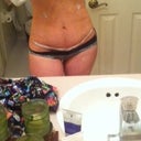2 days post op