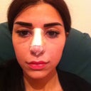 3rd day after surgery still some swelling